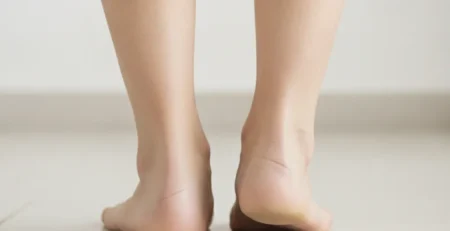 Pohled zezadu na paty, kde jedna pata vybočuje ven a Achillova šlacha se zalamuje ven.